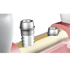 L’implantologia senza aumentazione ossea